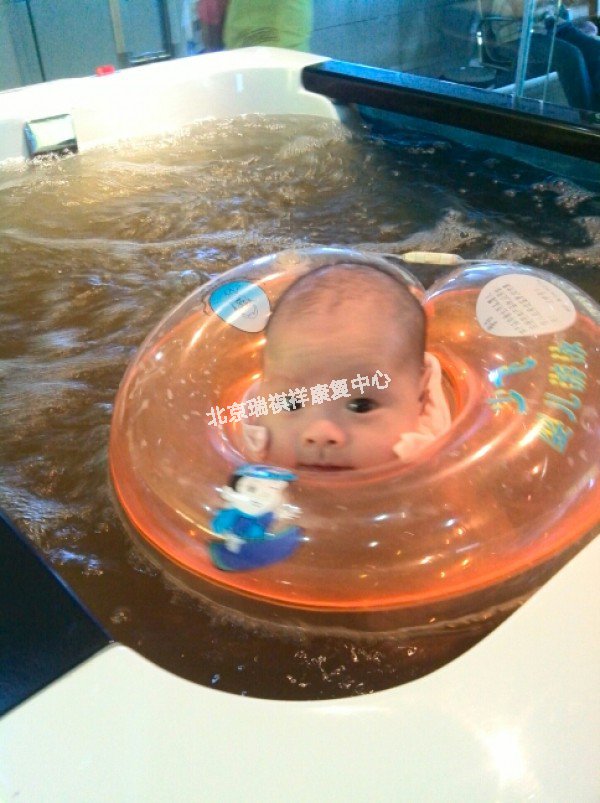 中药水疗对脑瘫儿童的治