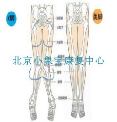 X型腿的最佳矫正年龄是多